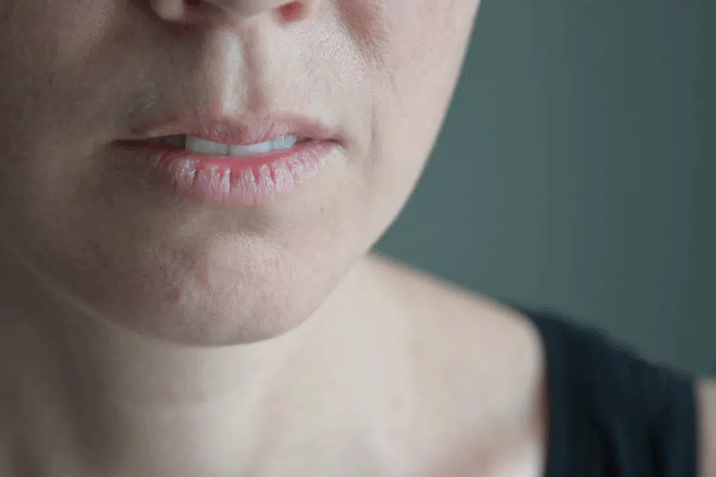 Dry Mouth Photo Credit Canva Pro Stock Image