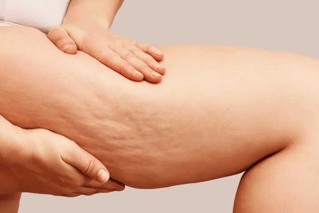 cellulite Photo Credit Canva Pro Stock Image